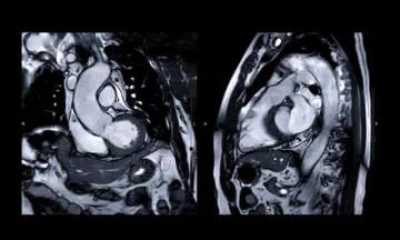 IMAGE IRM CARDIAQUE